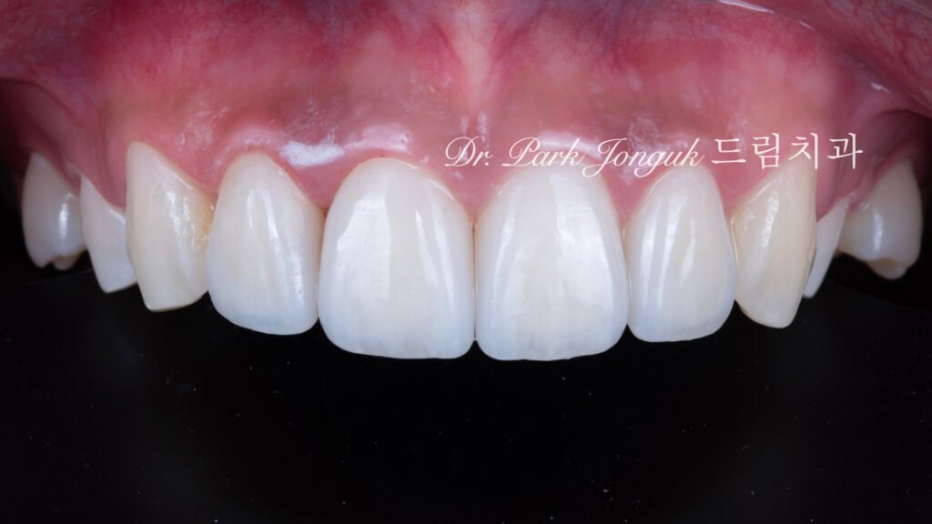 앞니 라미네이트 재시술