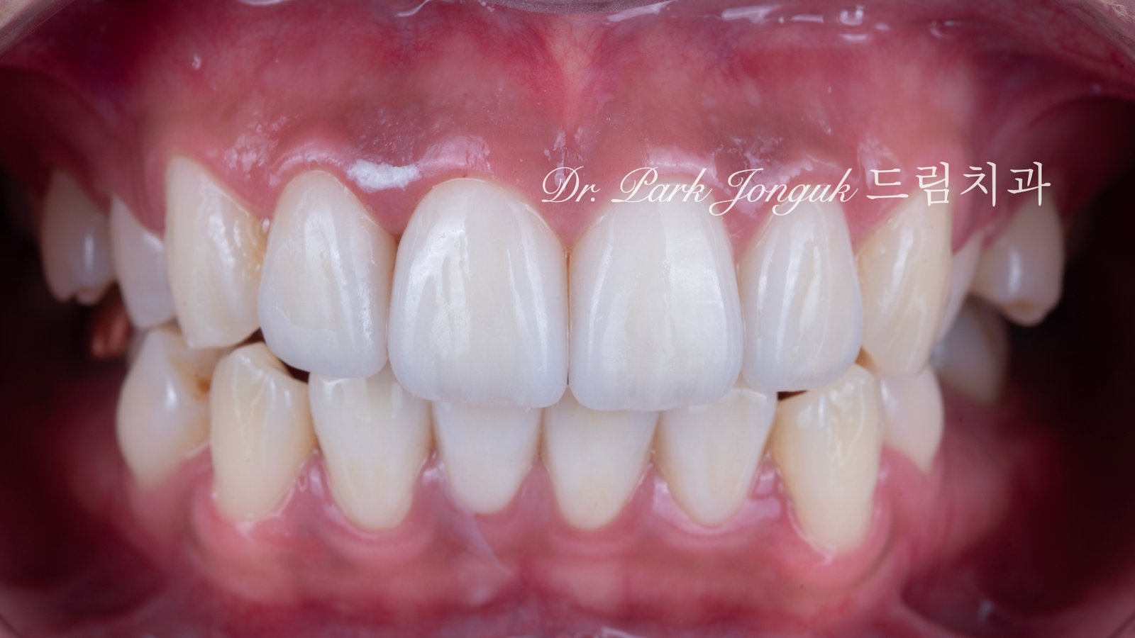 앞니 라미네이트 재시술