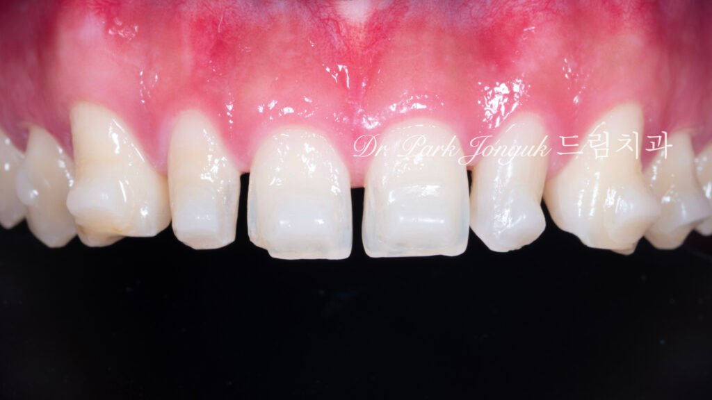 인비절라인 후 무삭제 라미네이트