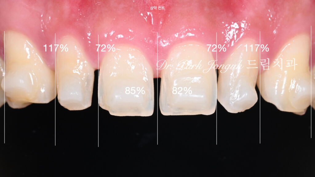 인비절라인 후 무삭제 라미네이트