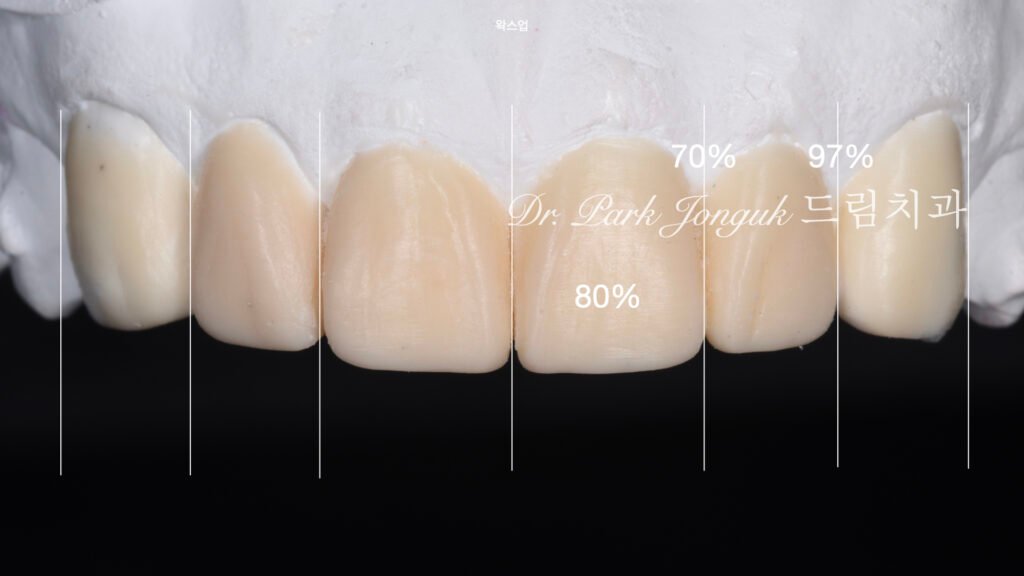 인비절라인 후 무삭제 라미네이트