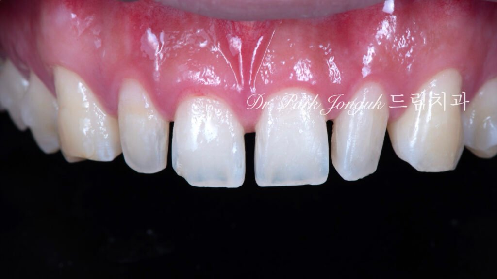 인비절라인 후 무삭제 라미네이트