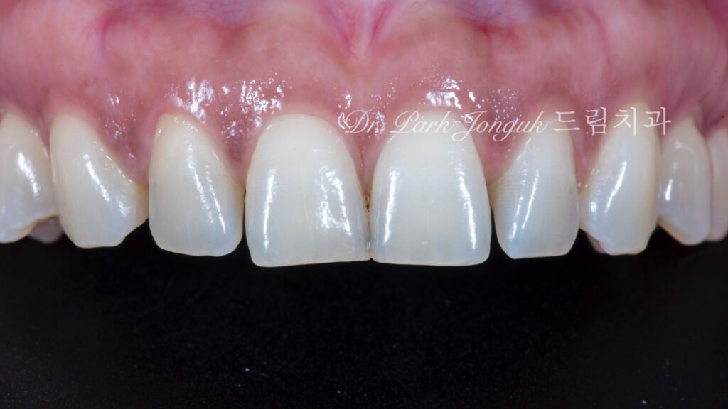 벌어진 앞니 치아 라미네이트