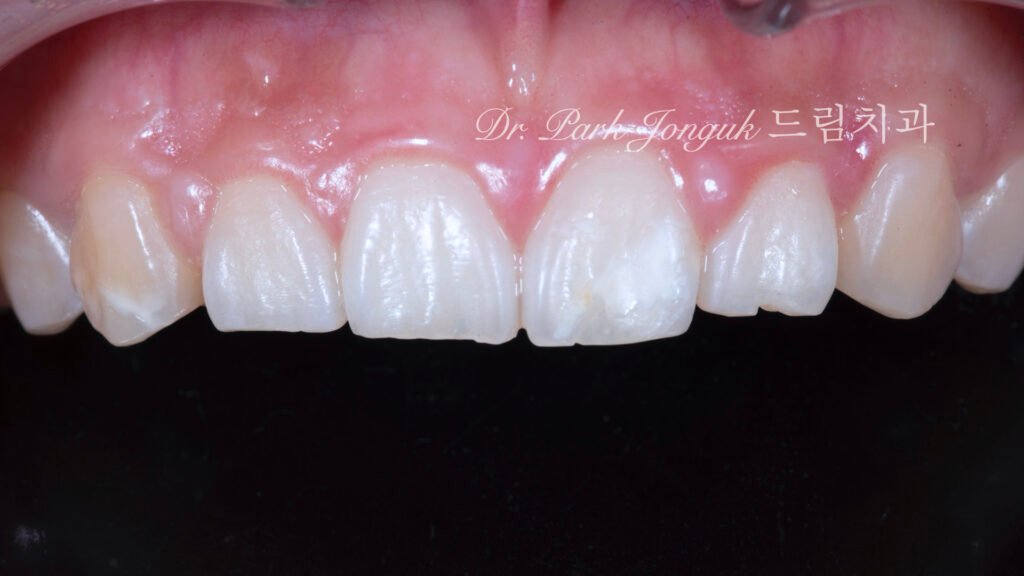 앞니 라미네이트