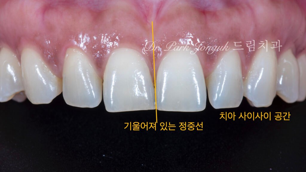 벌어진 앞니 치아 라미네이트