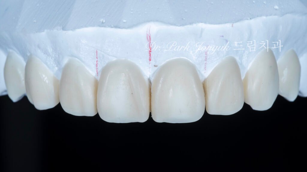 벌어진 앞니 치아 라미네이트