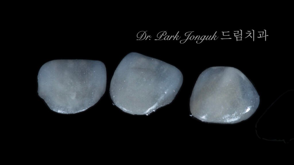 앞니 라미네이트