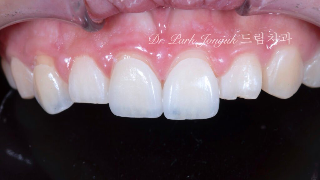 앞니 라미네이트