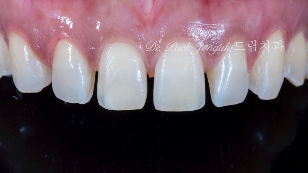 벌어진 앞니 치아 라미네이트