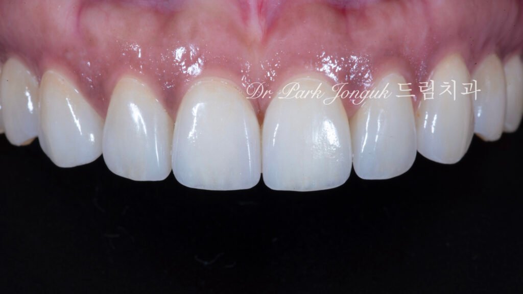벌어진 앞니 치아 라미네이트