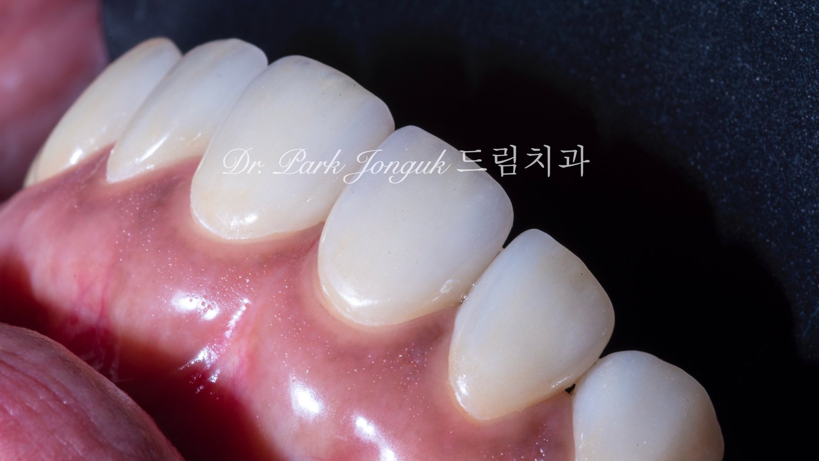 벌어진 앞니 치아 라미네이트