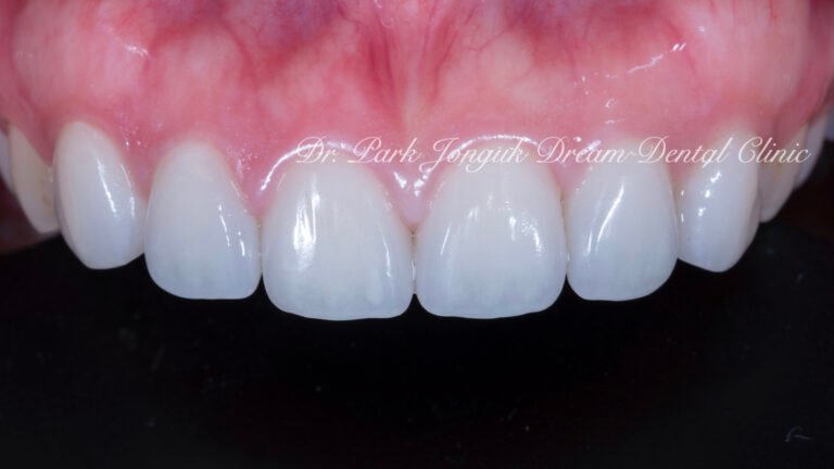 앞니 올세라믹 재시술