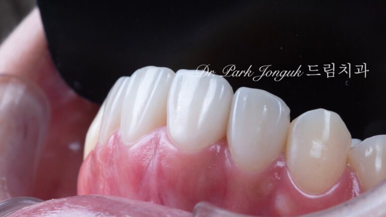 앞니 토끼이 라미네이트