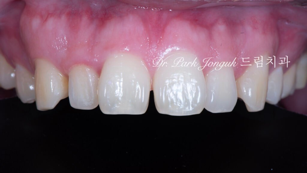 벌어진 앞니 토끼이 왜소치 라미네이트