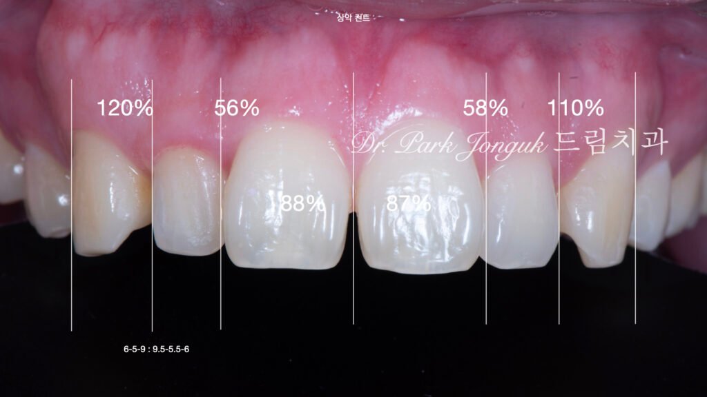 벌어진 앞니 토끼이 왜소치 라미네이트