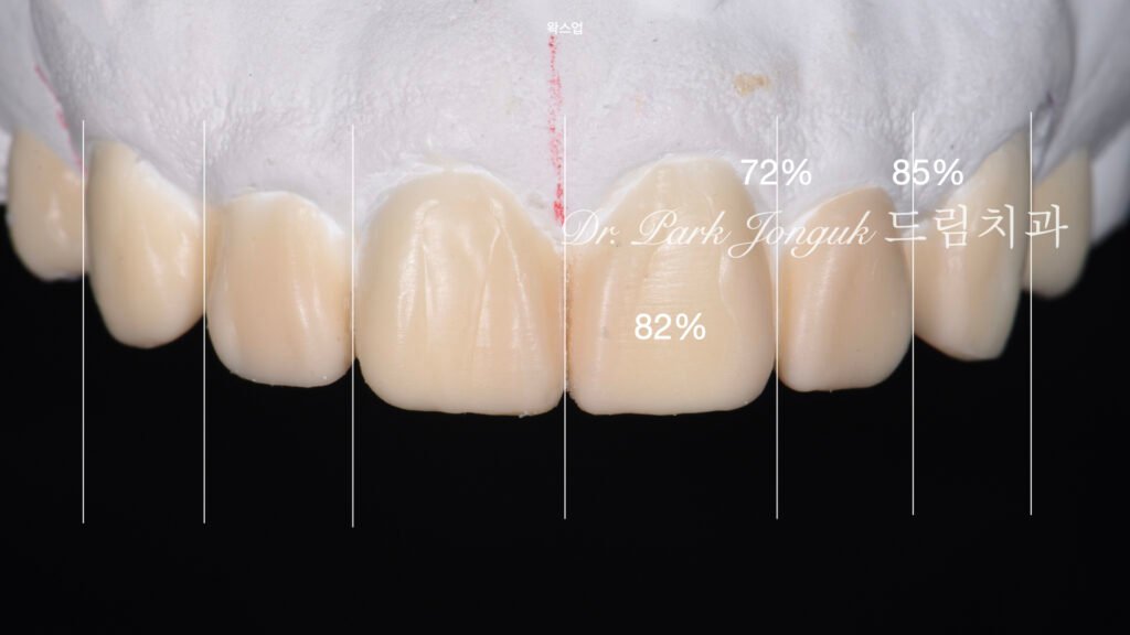벌어진 앞니 토끼이 왜소치 라미네이트