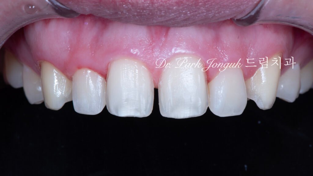 벌어진 앞니 토끼이 왜소치 라미네이트