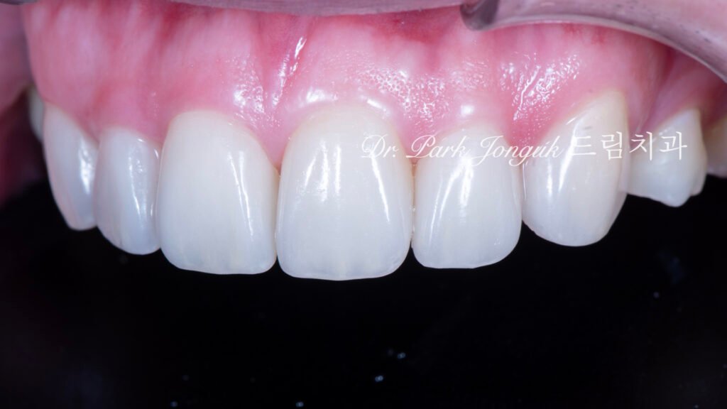 벌어진 앞니 토끼이 왜소치 라미네이트