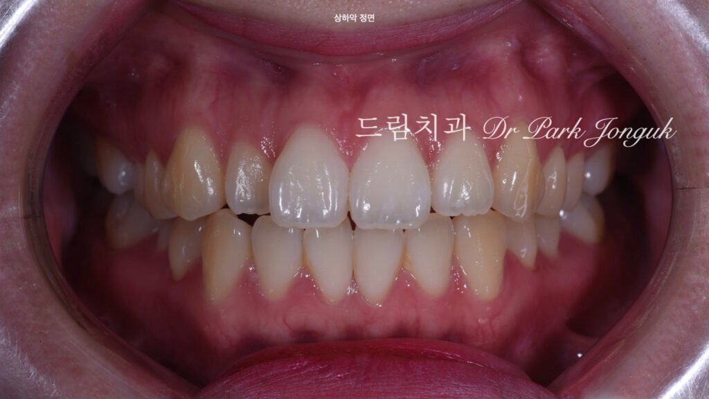 강남 토끼이 라미네이트 잘하는곳