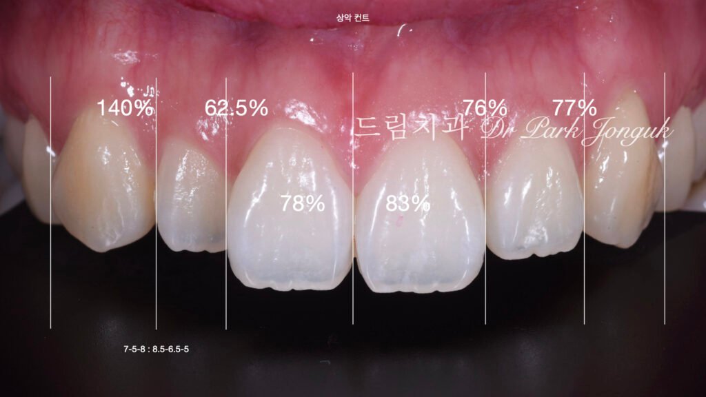 강남 토끼이 라미네이트 잘하는곳