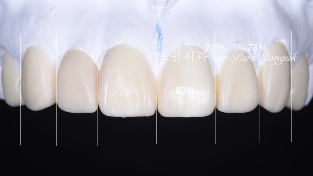 강남 토끼이 라미네이트 잘하는곳