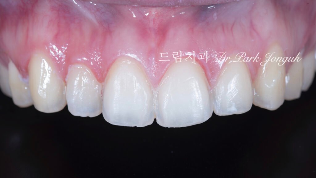 강남 토끼이 라미네이트 잘하는곳