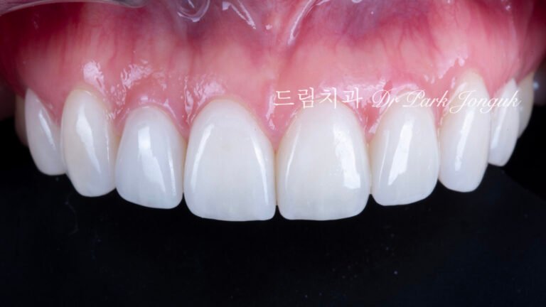 강남 토끼이 라미네이트 잘하는 곳