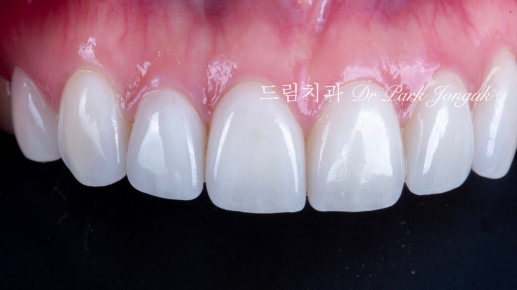 강남 토끼이 라미네이트 잘하는곳