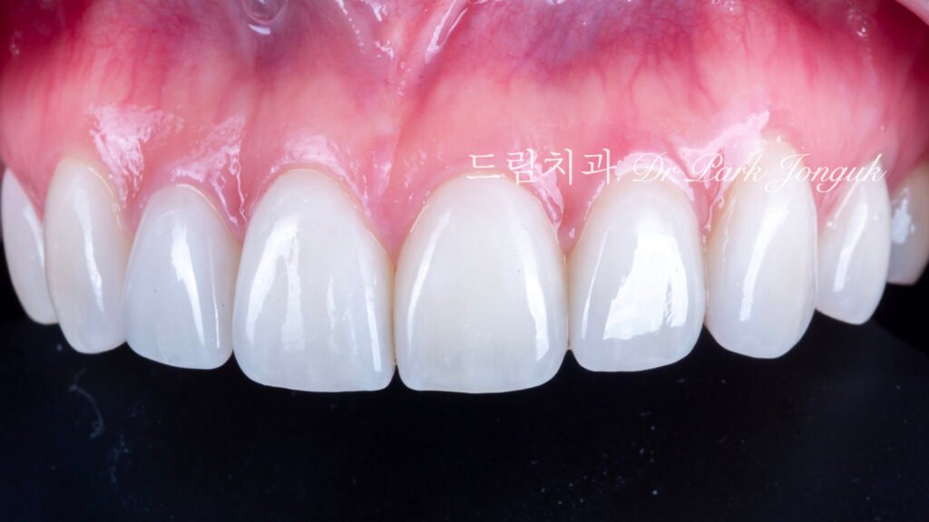 강남 토끼이 라미네이트 잘하는곳