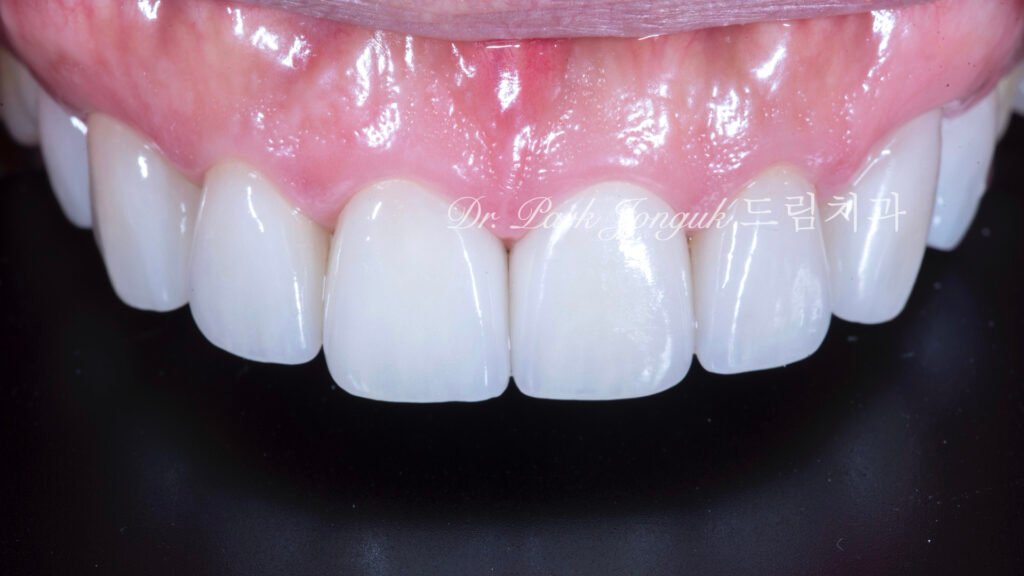 50대라미네이트, 치아노화라미네이트, 치아마모라미네이트, AgingTeeth, LaminateVeneers, ToothWear, 심미치과, 앞니라미네이트, 자연스러운라미네이트, 동안치아