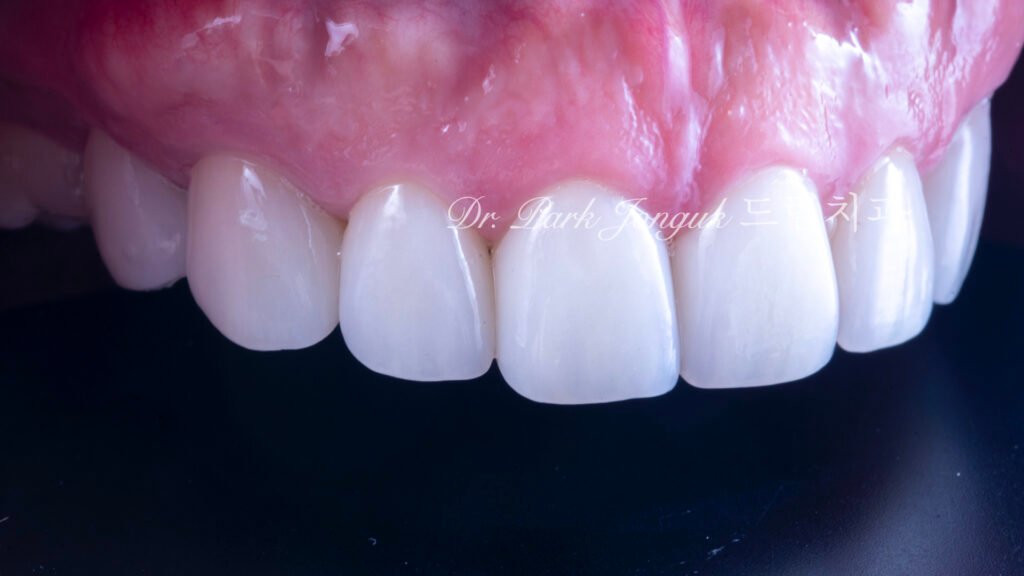 50대라미네이트, 치아노화라미네이트, 치아마모라미네이트, AgingTeeth, LaminateVeneers, ToothWear, 심미치과, 앞니라미네이트, 자연스러운라미네이트, 동안치아