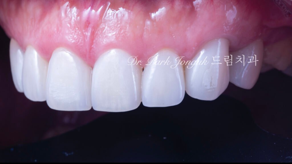 50대라미네이트, 치아노화라미네이트, 치아마모라미네이트, AgingTeeth, LaminateVeneers, ToothWear, 심미치과, 앞니라미네이트, 자연스러운라미네이트, 동안치아