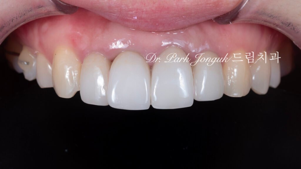 라미네이트 재시술, Laminate Revision, 올세라믹 크라운 재치료, All-Ceramic Crown Revision