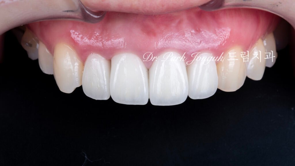 라미네이트 재시술, Laminate Revision, 올세라믹 크라운 재치료, All-Ceramic Crown Revision