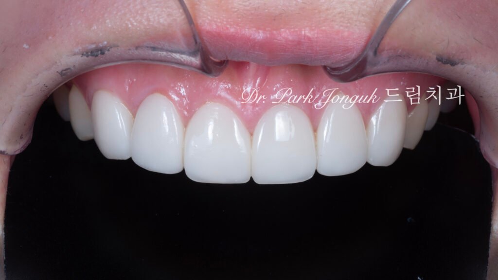 라미네이트 재시술, Laminate Revision, 올세라믹 크라운 재치료, All-Ceramic Crown Revision