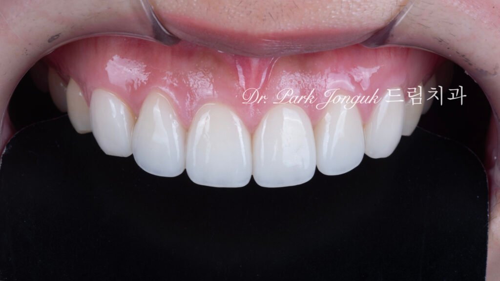 라미네이트 재시술, Laminate Revision, 올세라믹 크라운 재치료, All-Ceramic Crown Revision