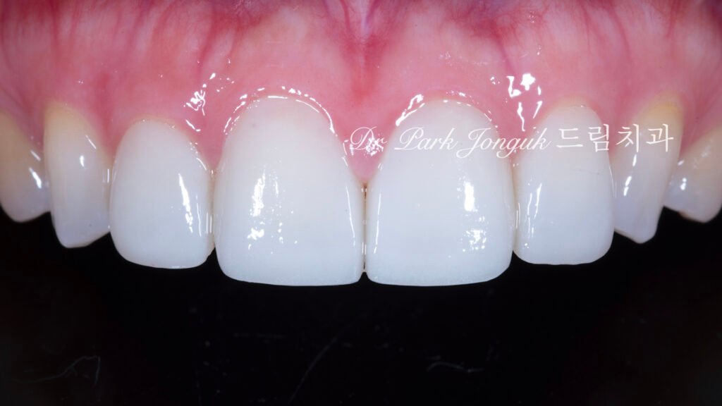 라미네이트 재시술, Laminate Revision, 올세라믹 크라운 재치료, All-Ceramic Crown Revision