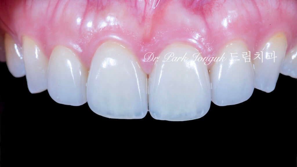 라미네이트 재시술, Laminate Revision, 올세라믹 크라운 재치료, All-Ceramic Crown Revision