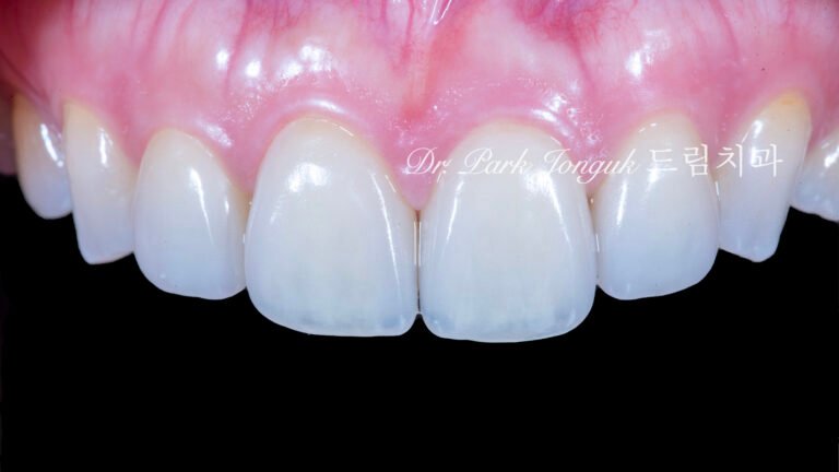 라미네이트 재시술, Laminate Revision, 올세라믹 크라운 재치료, All-Ceramic Crown Revision, 심미 보철 재건, Esthetic Prosthetic Reconstruction, 수작업 빌드업, Hand-Layered Build-up