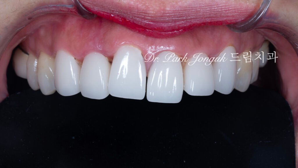 라미네이트 재시술, Laminate Revision, 올세라믹 크라운 재치료, All-Ceramic Crown Revision