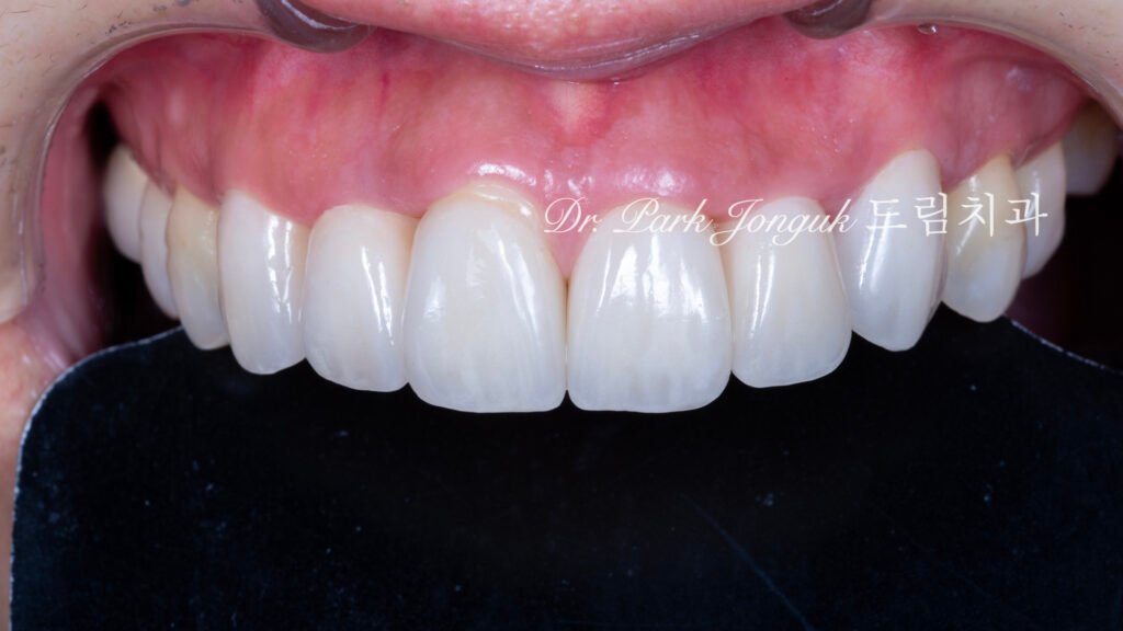 라미네이트 재시술, Laminate Revision, 올세라믹 크라운 재치료, All-Ceramic Crown Revision