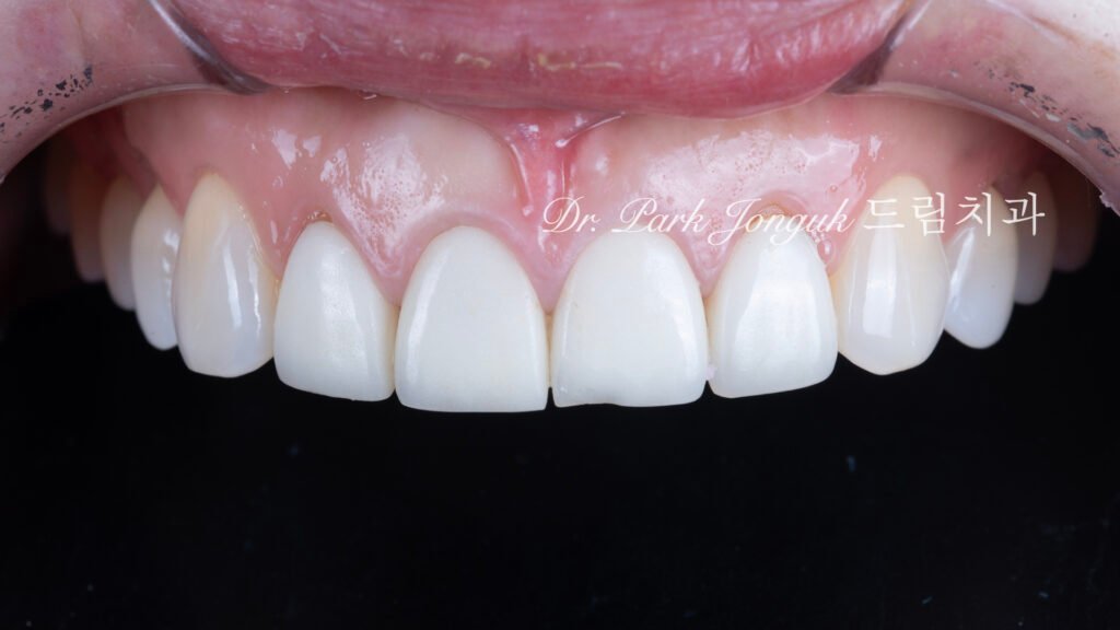 라미네이트 재시술, Laminate Revision, 올세라믹 크라운 재치료, All-Ceramic Crown Revision