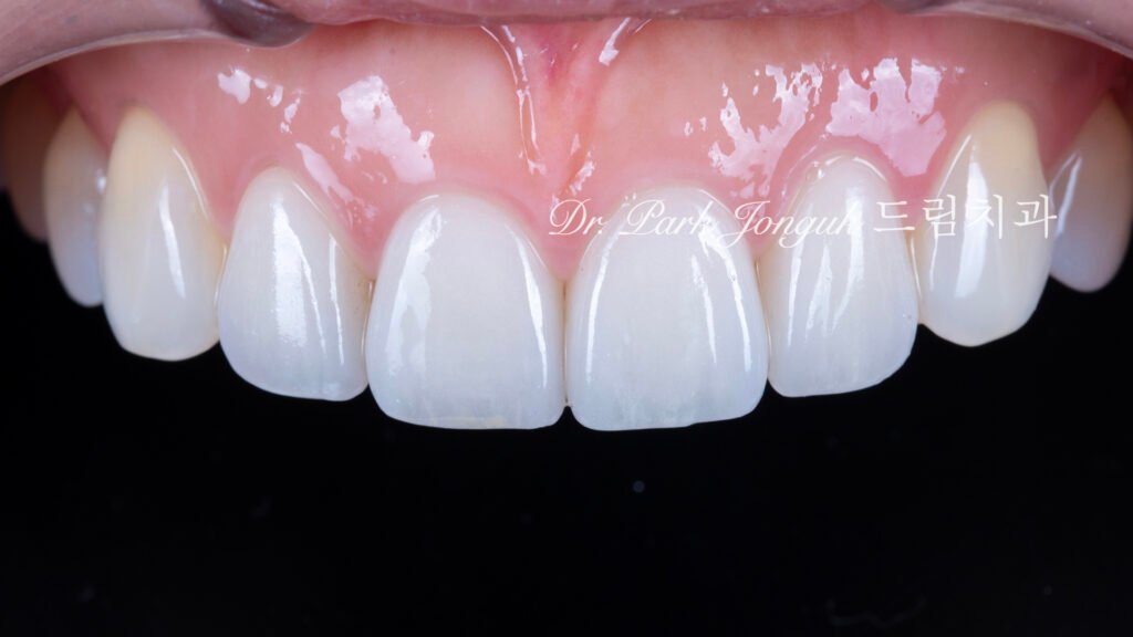 라미네이트 재시술, Laminate Revision, 올세라믹 크라운 재치료, All-Ceramic Crown Revision