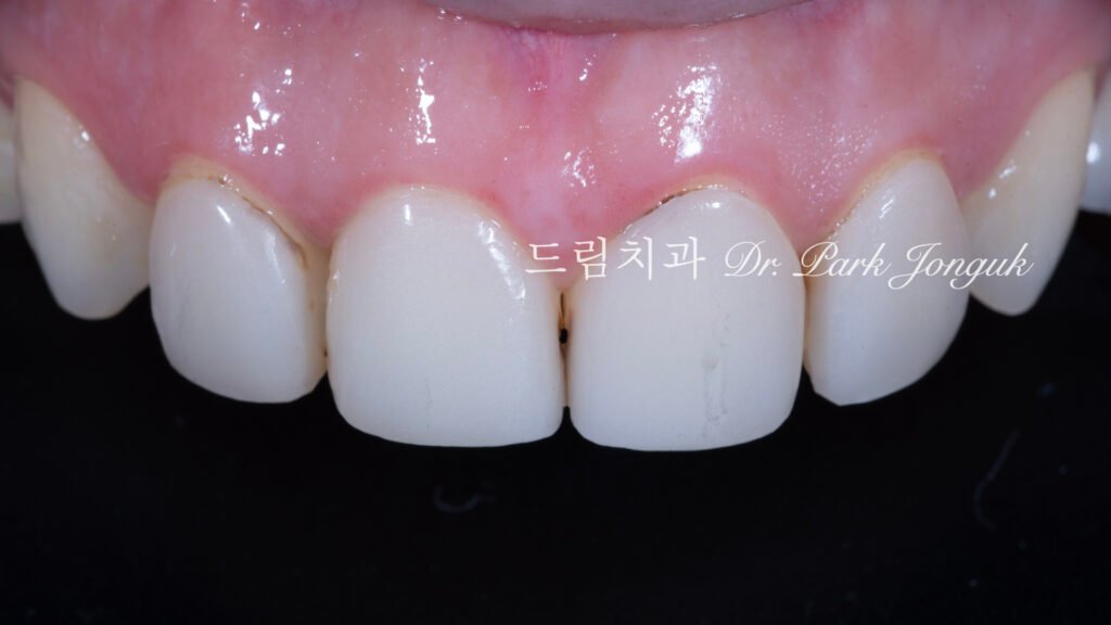 라미네이트 재시술 레이저 제거