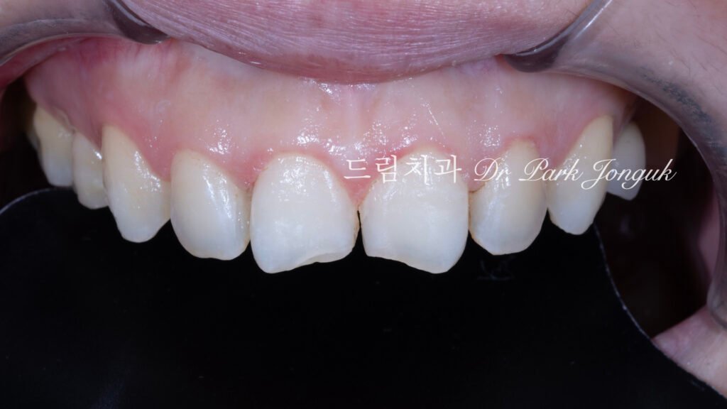 라미네이트 재시술 레이저 제거