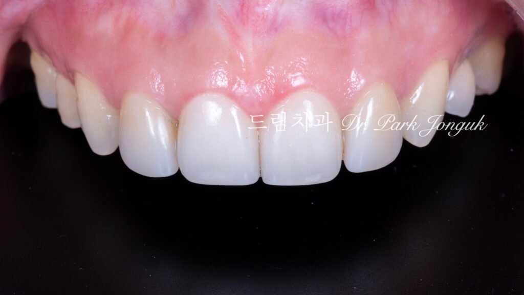 라미네이트 재시술 레이저 제거