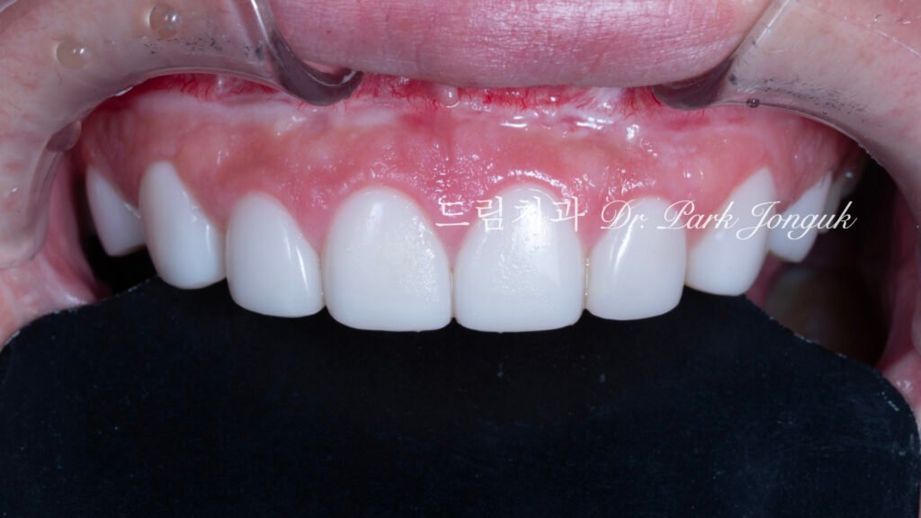 라미네이트 재시술 레이저 제거