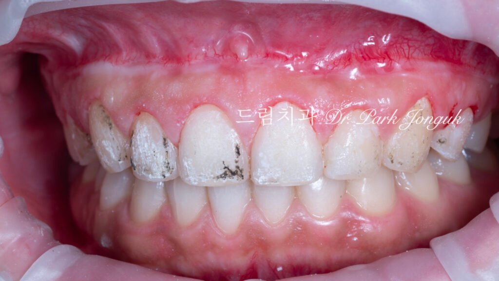 라미네이트 재시술 레이저 제거