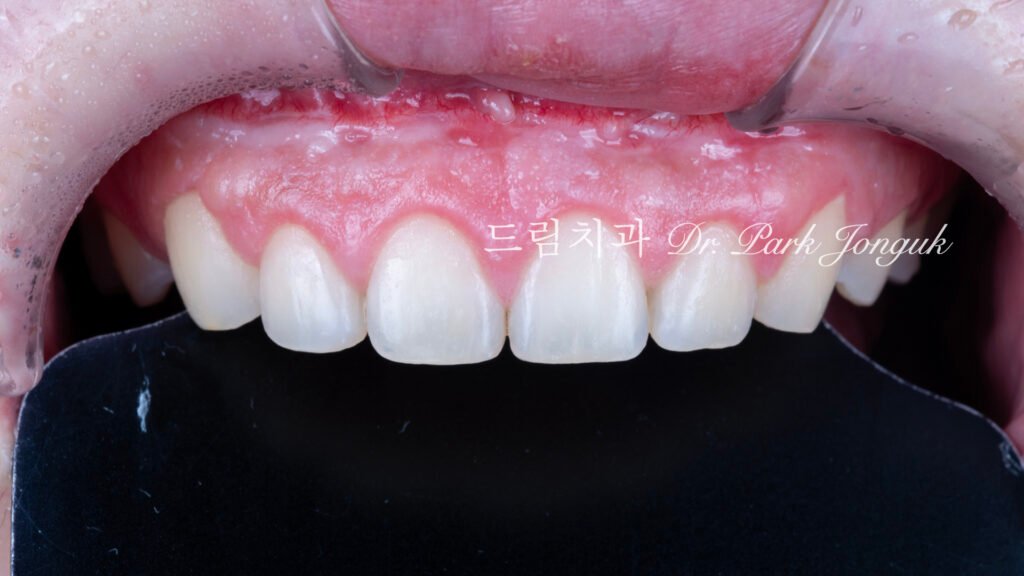 라미네이트 재시술 레이저 제거