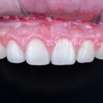 라미네이트 재시술 레이저 제거